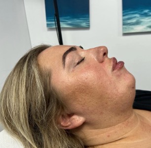 Lip augmentation immediate result
