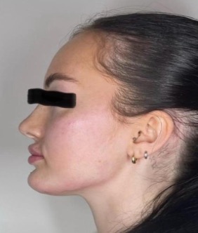 Chin and jawline after treatment