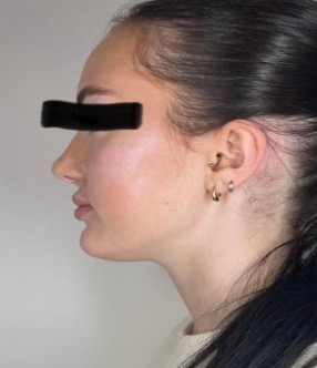 Chin and jawline before treatment