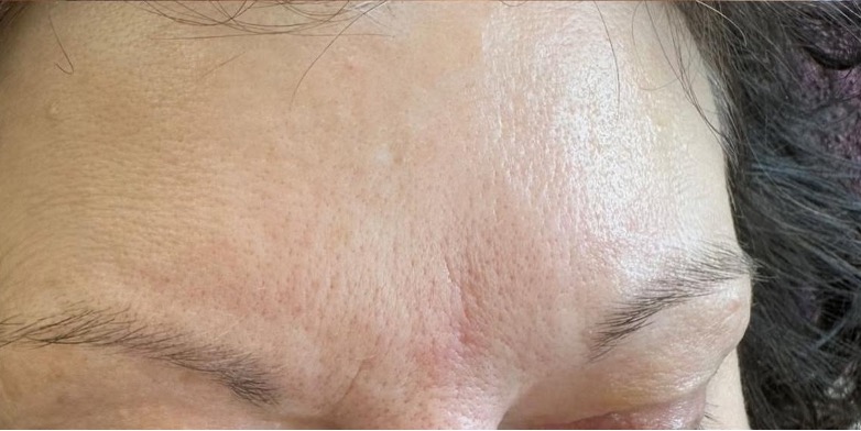 Forehead after neuromodulation treatment