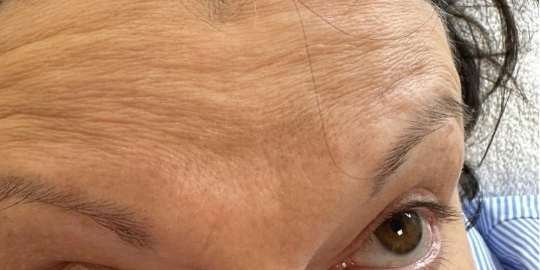 Forehead before neuromodulation treatment