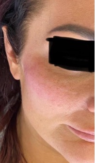 Mid-face after treatment