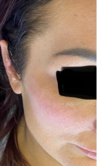 Mid-face before treatment